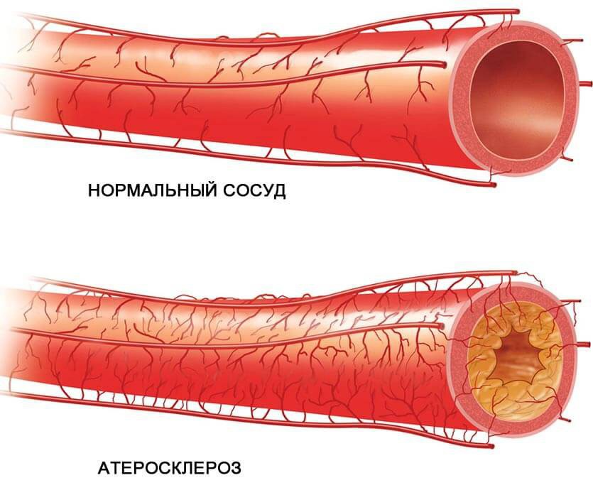Борьба с атеросклерозом бедренной артерии